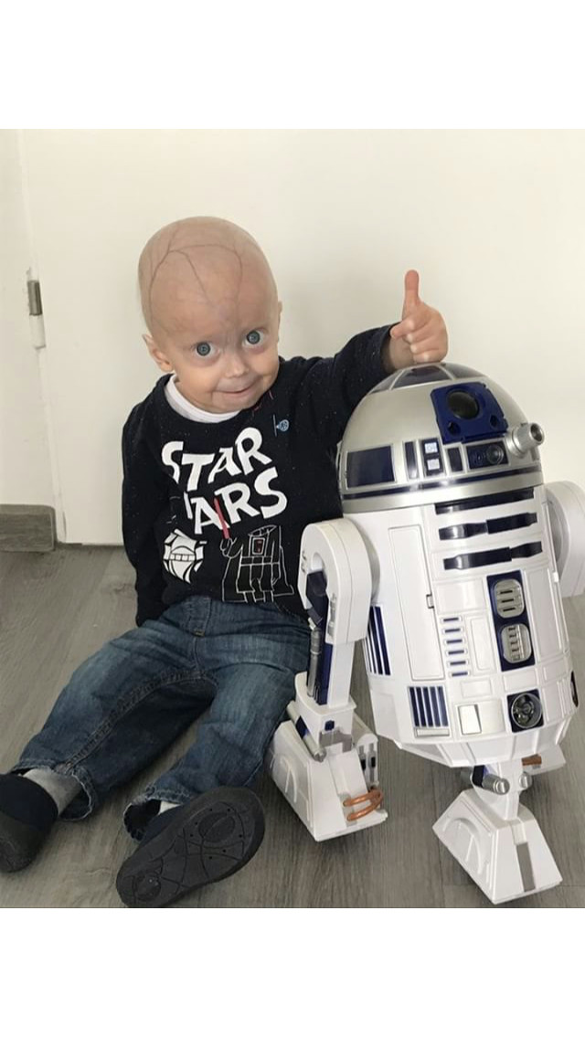 A Beautiful Life with Luke- Progeria Story