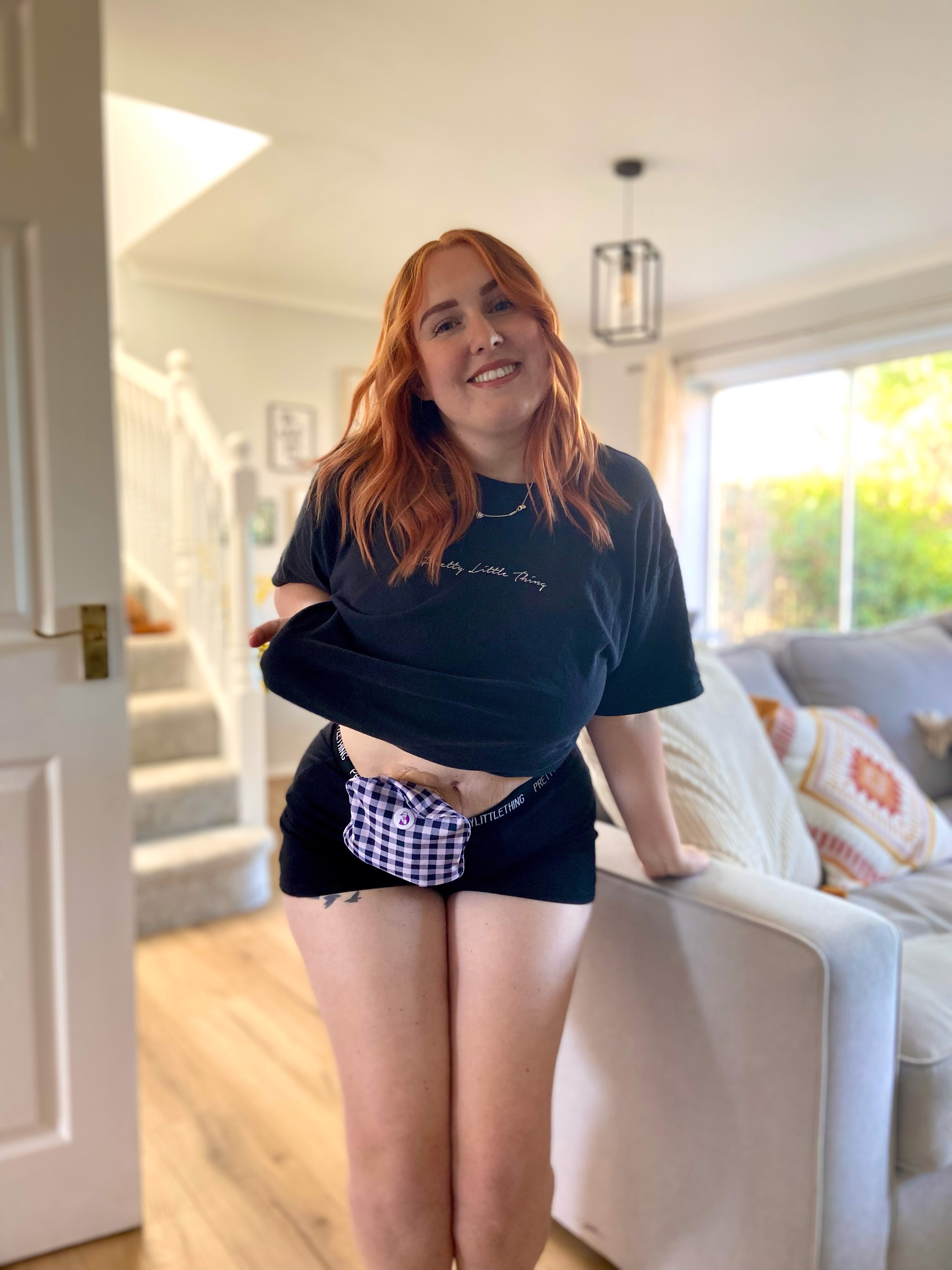 My Stoma Story