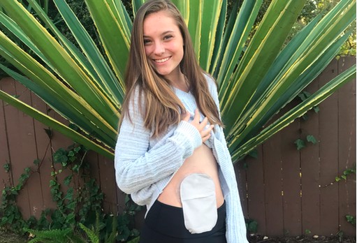 Embracing Your Disability with Ulcerative Colitis