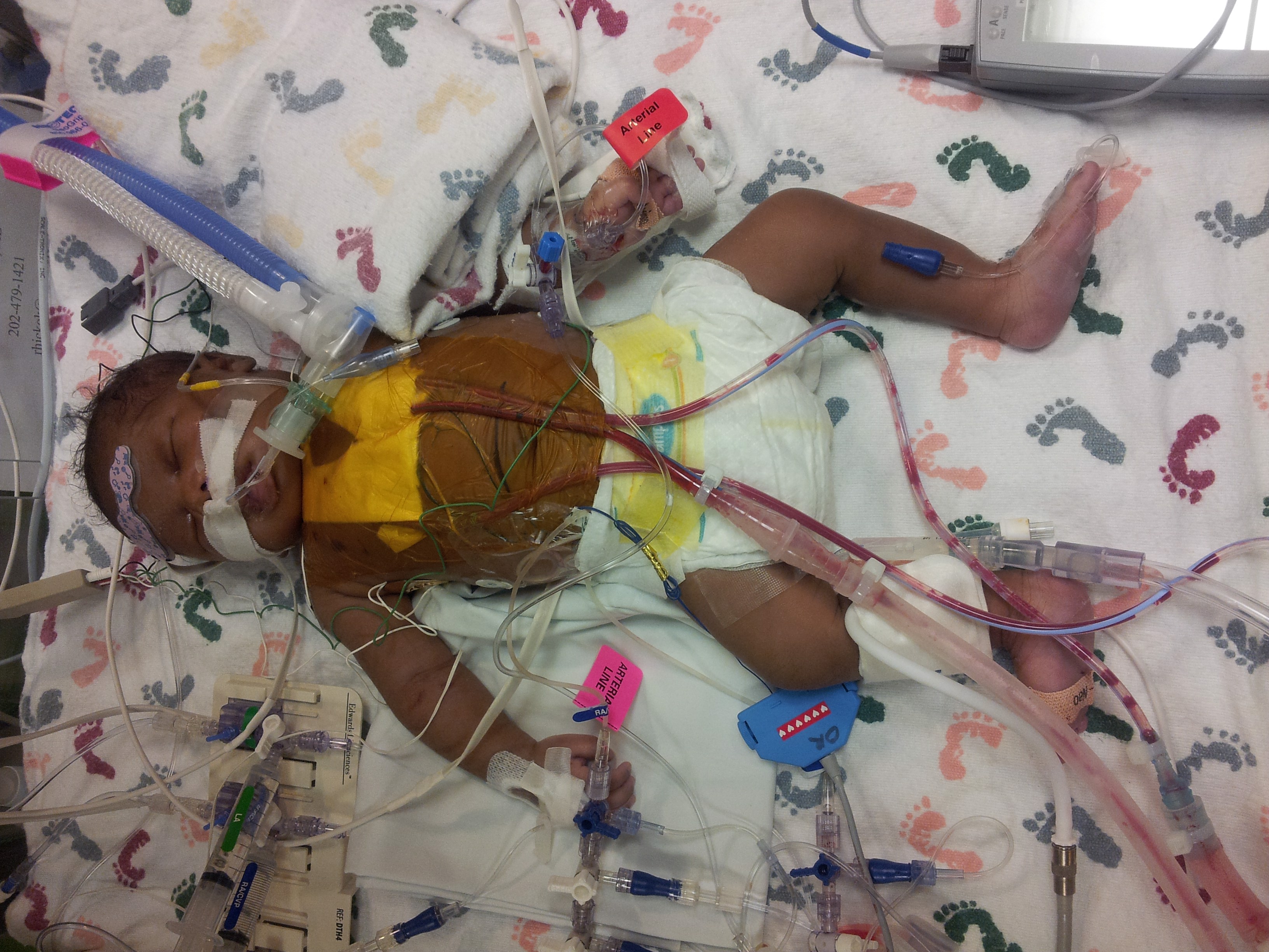 Heartwarming Father and Son Story: Congenital Heart Defect