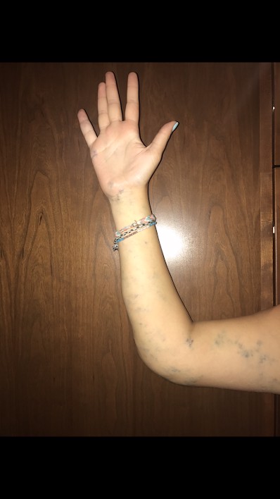 Born with My Own Constellation: Birthmark Awareness