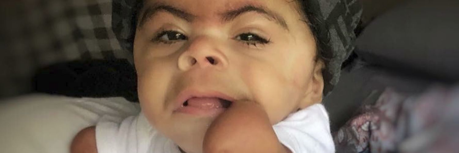 What Is CdLS? | Cornelia de Lange Syndrome