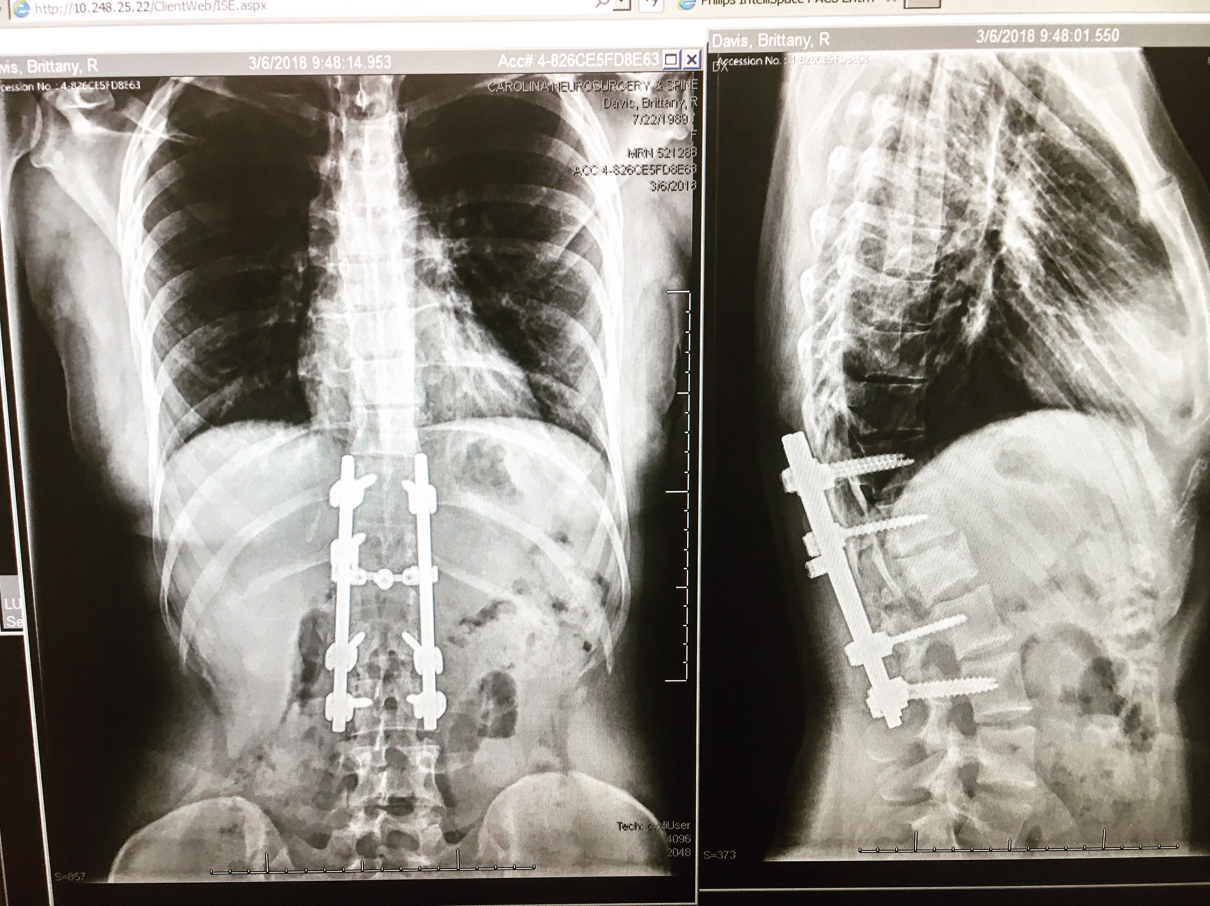 From Paralyzed and Broken to climbing in the World Championships