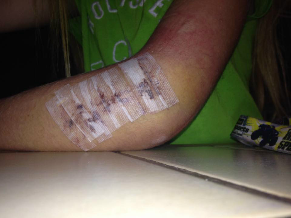 I Fight Osteogenesis Imperfecta & Traumatic Brain Injury