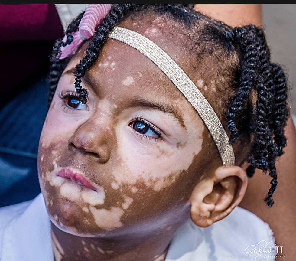 How to live with Cerebral Palsy and Vitiligo
