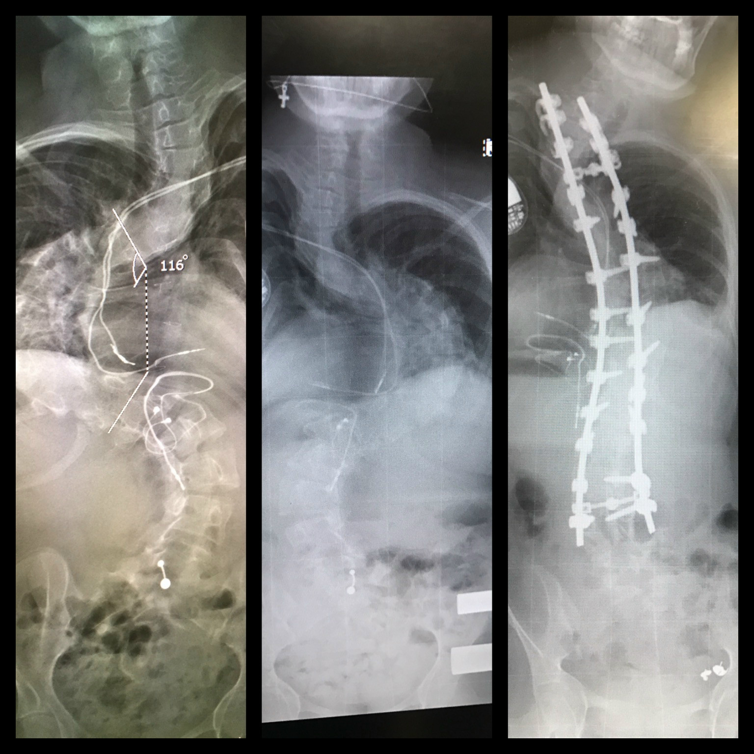 Bendy Spine, Silly Mind: Scoliosis