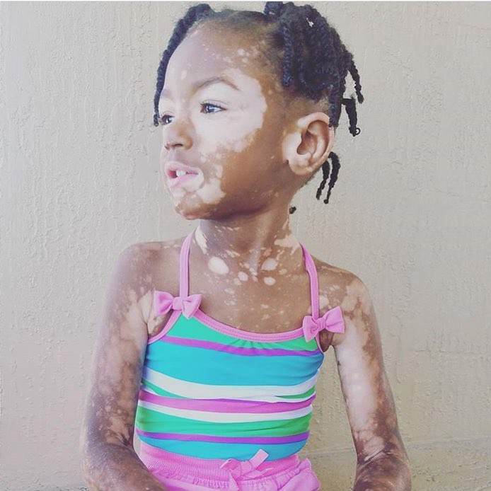 How to live with Cerebral Palsy and Vitiligo