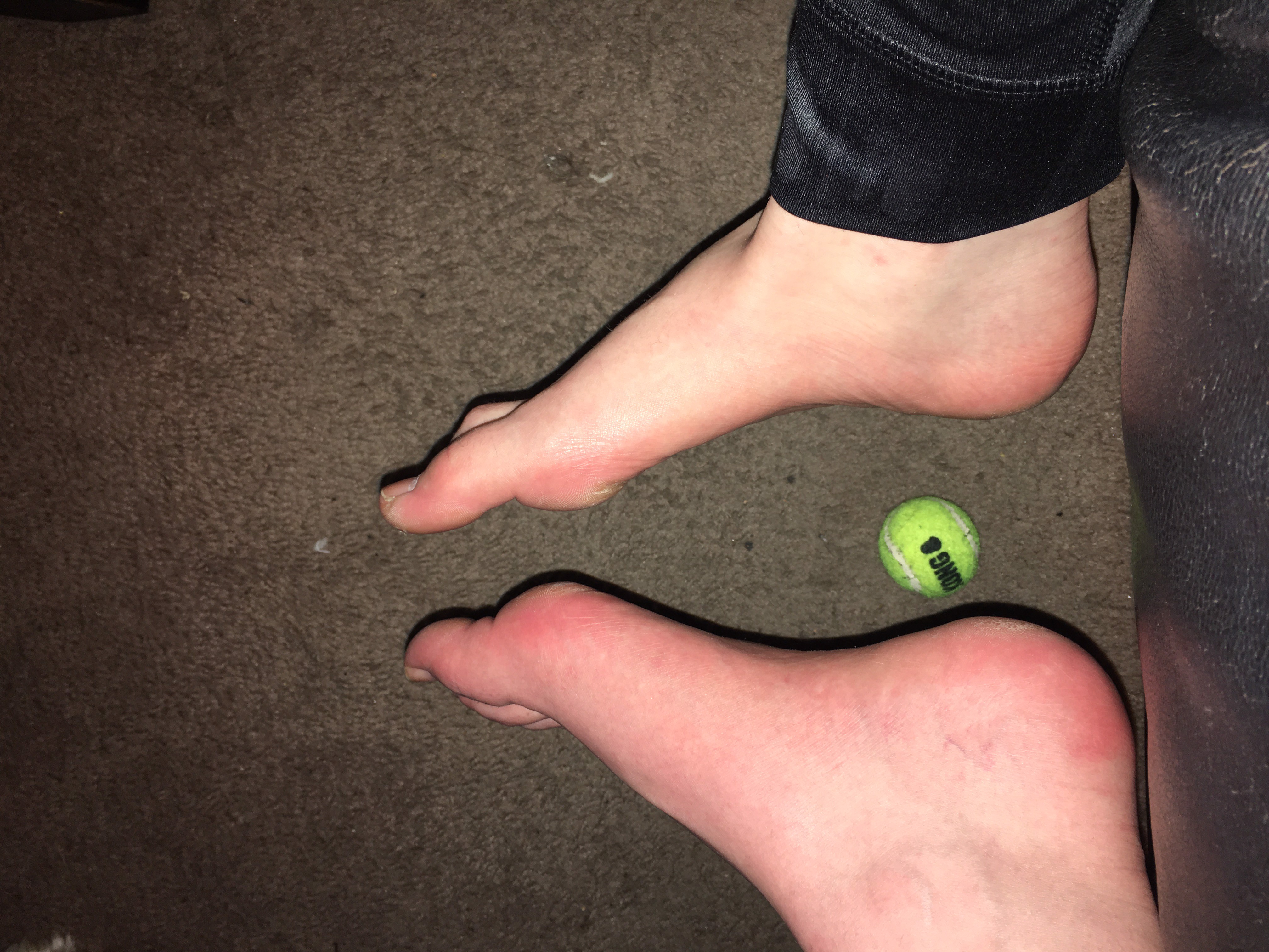 Burning to Live with Complex Regional Pain Syndrome