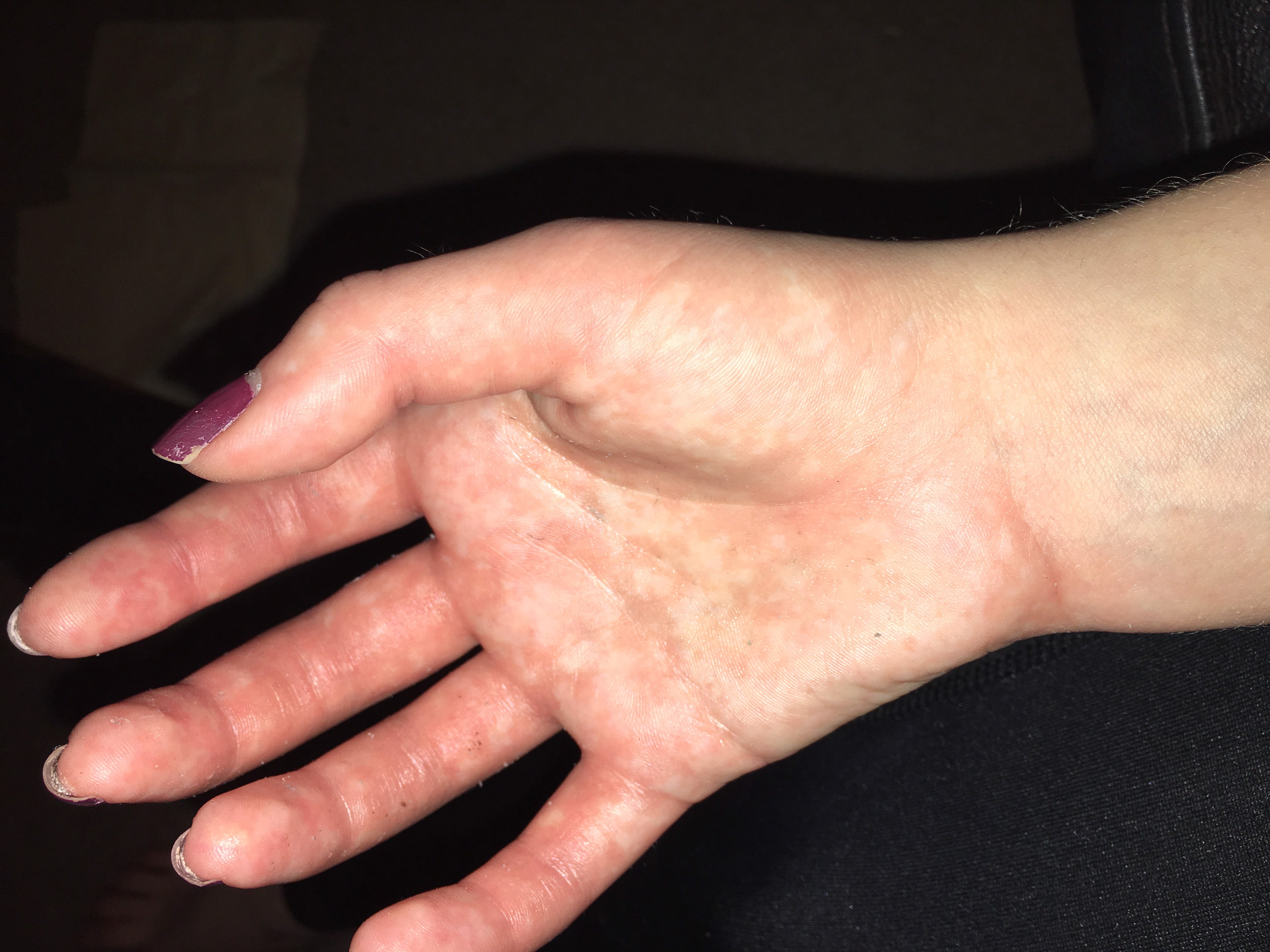 Burning to Live with Complex Regional Pain Syndrome