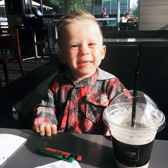 Superbaby with Sacral Agenesis