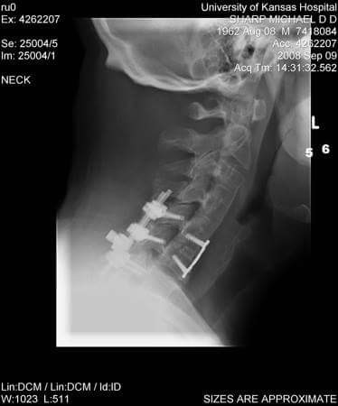 How A Bike Accident Caused My Traumatic Brain Injury