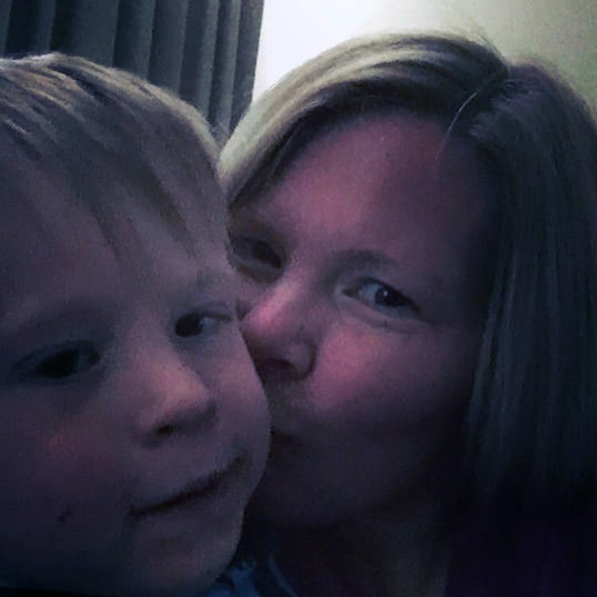 Superbaby with Sacral Agenesis