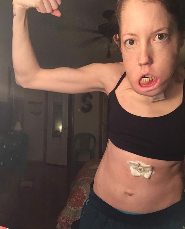 Feeding Tube Fitness