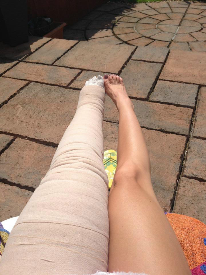 My Beef and Chicken Legs: Life with Congenital Lymphoedema