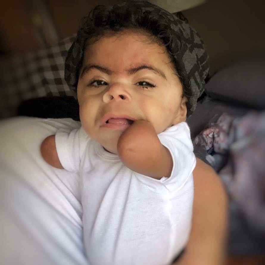 What Is CdLS? | Cornelia de Lange Syndrome