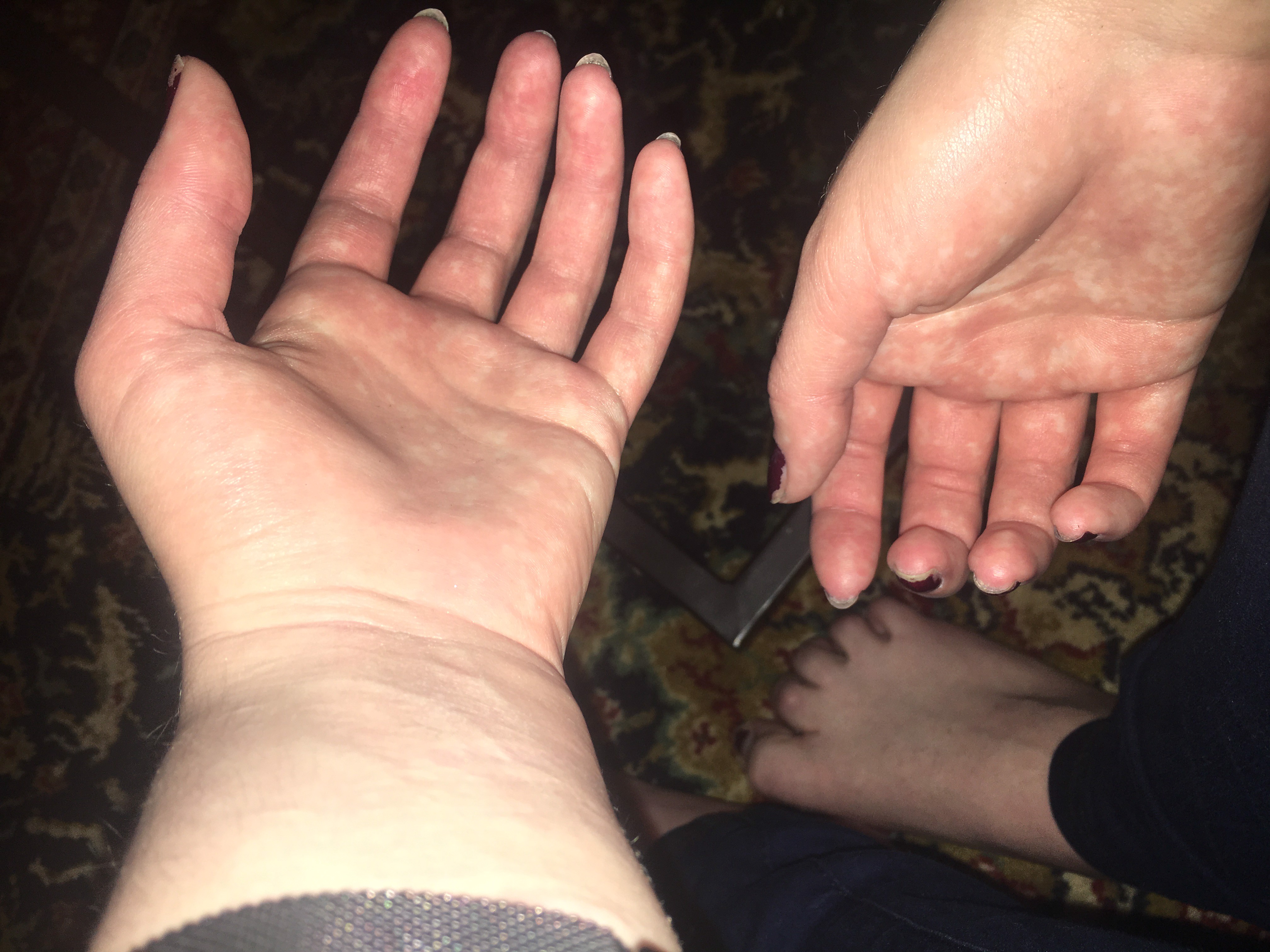 Burning to Live with Complex Regional Pain Syndrome