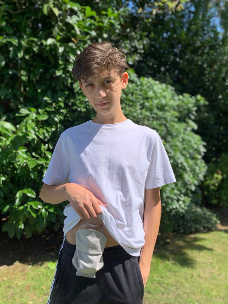 My story with a stoma at just 16 !