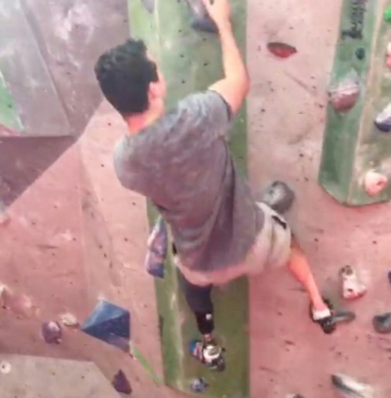 How I have Learned to be Positive in Becoming an Amputee