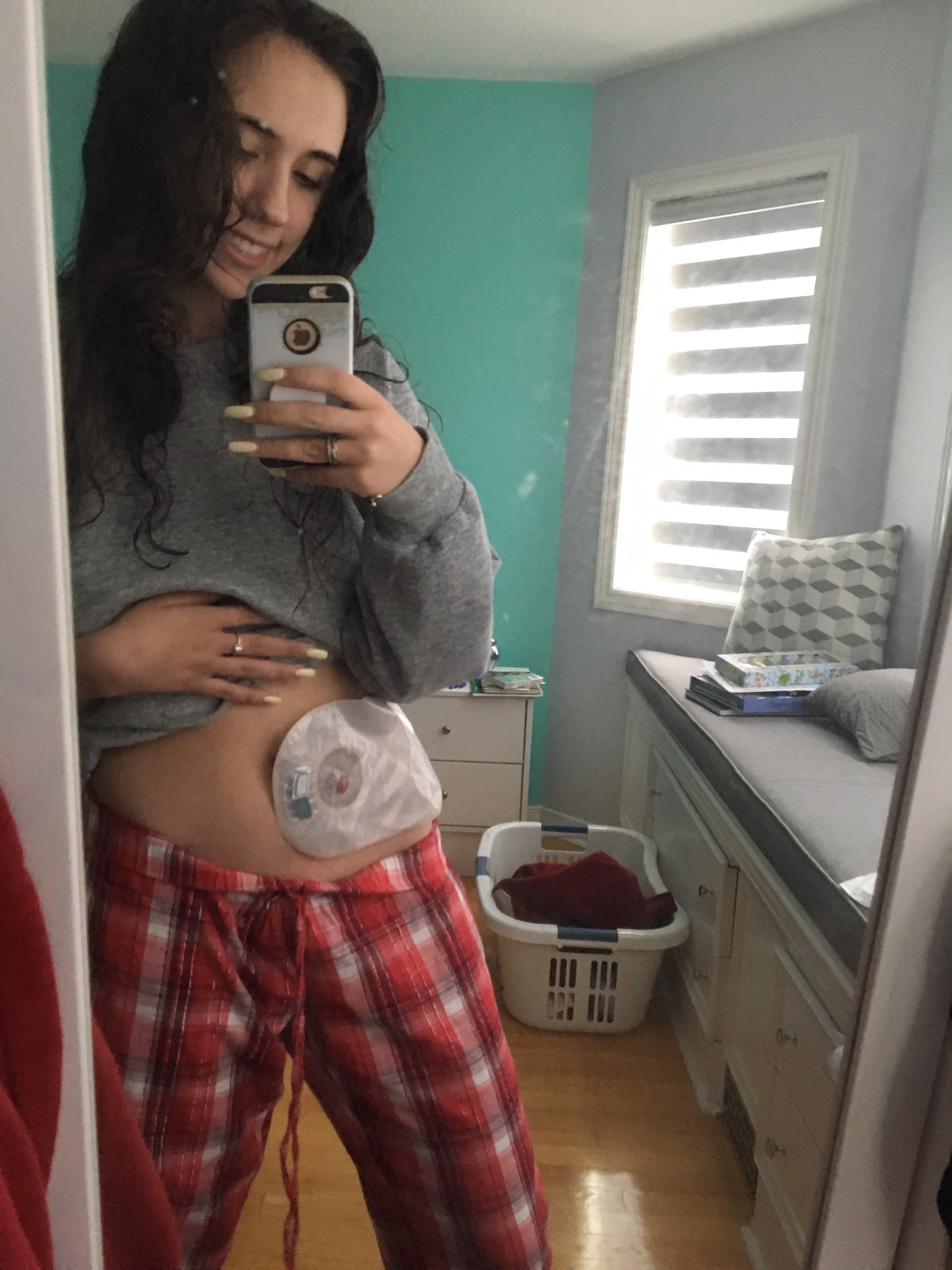 My Journey with Ulcerative Colitis