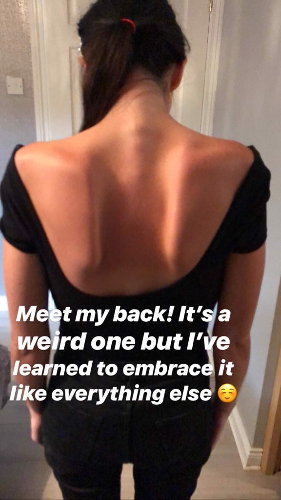 Living life with Muscular Dystrophy (MD) and ME