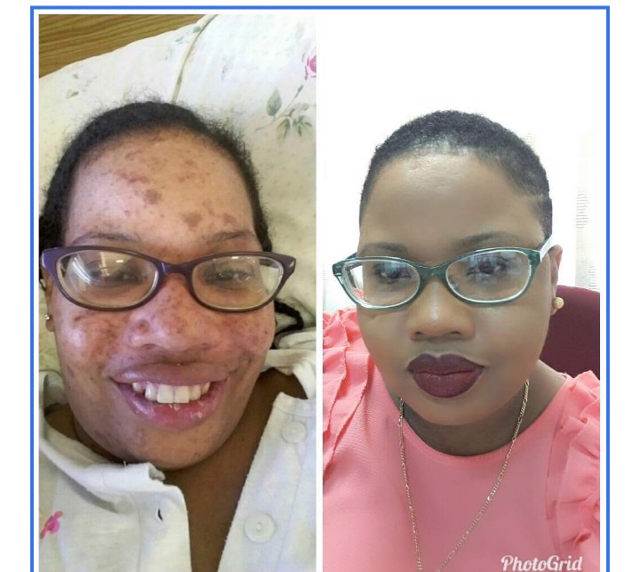 My Lupus Journey