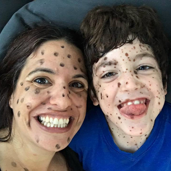 Living With A Rare Disease: Congenital Nevus