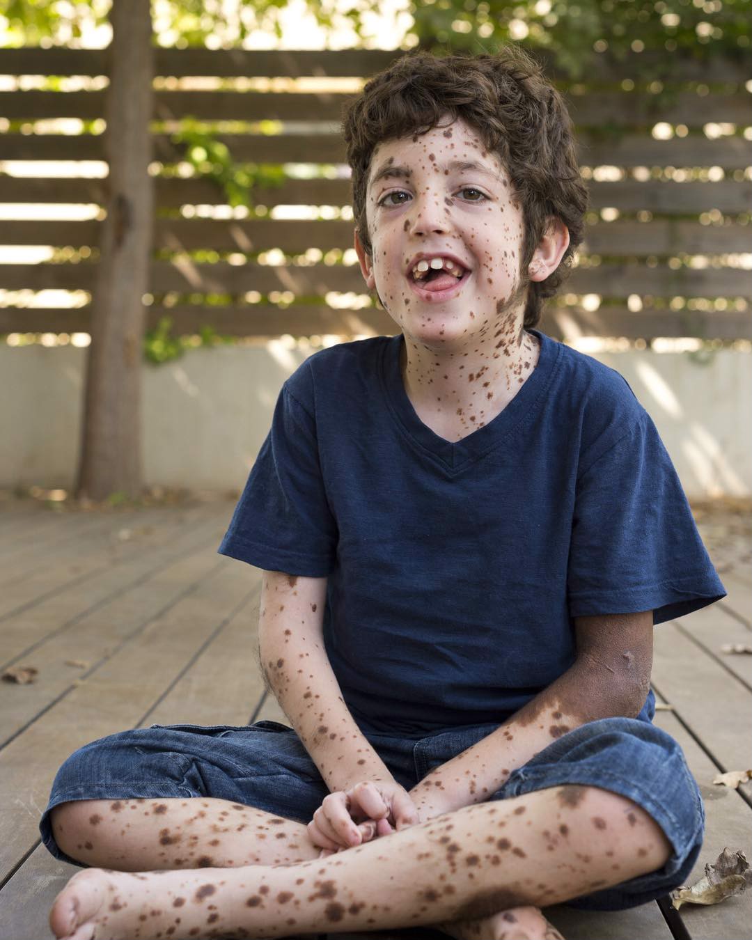 Living a Colorful Life with a Rare Disease