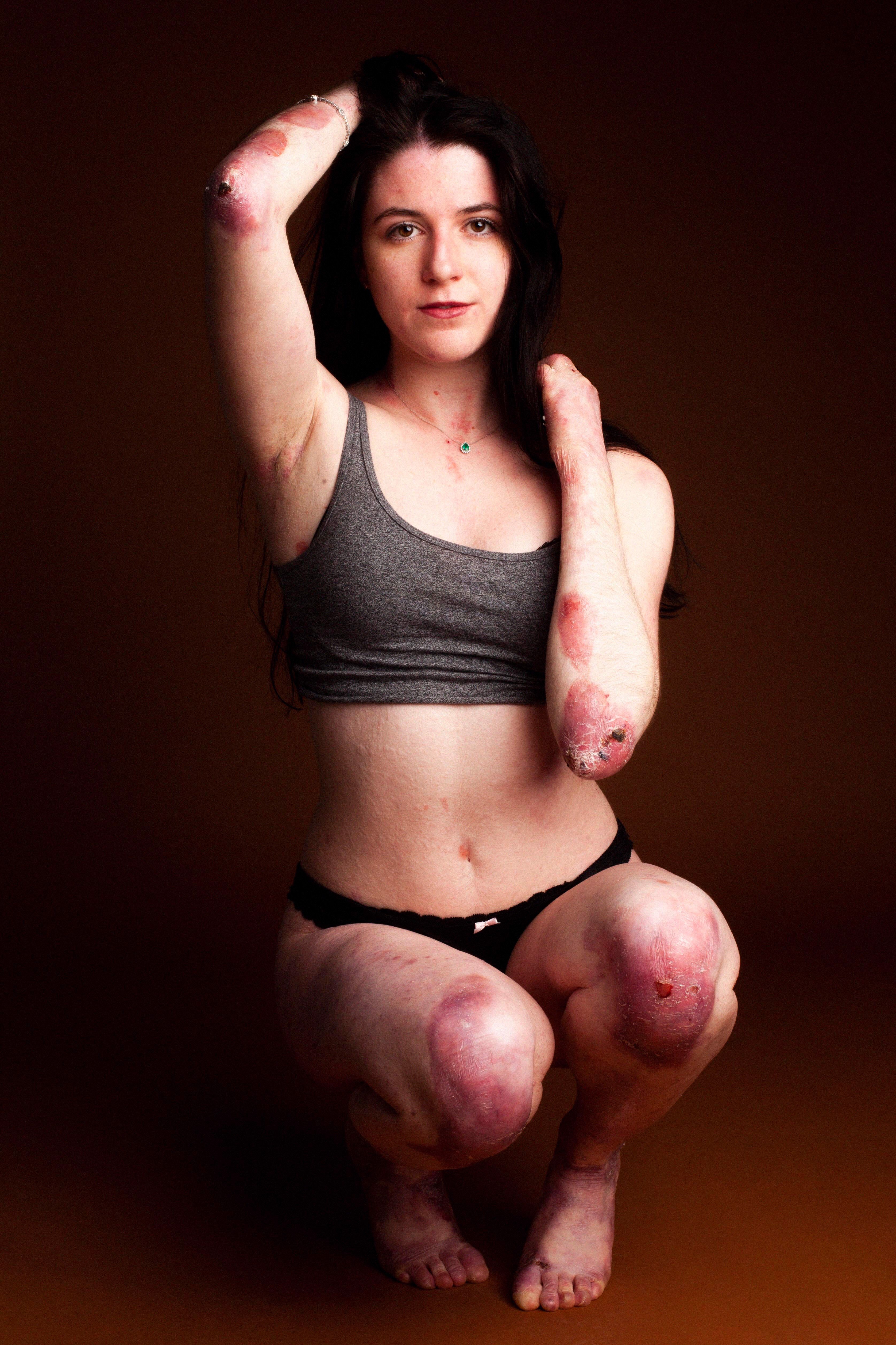 How to Live when You're Meant to Die: Living with a Rare Disease