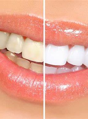 teeth white.jpg