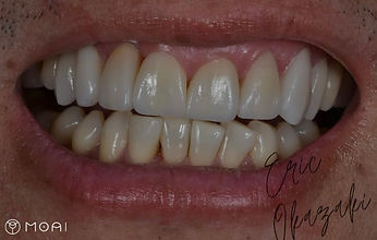 Paciente feliz após tratamento estético com facetas em porcelana na clinica odontológia moai, em moema, zona sul de são paulo