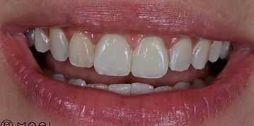 Clareamento Dental Caseiro realizado pelos dentistas da clinica moai odontologica em moema, zona sul de são paulo