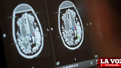Estudio señala que el volumen de la materia gris en el cerebro es alterado por la COVID-19
