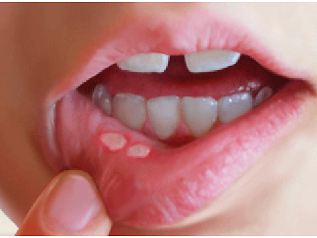 Gum disease treatment