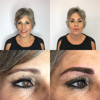 Brow Correction