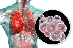Short vs. Long Antibiotic Course for Ventilator-associated Pneumonia (VAP) and Pseudomonas VAP