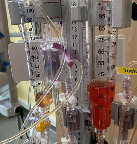 Should early lumbar cerebrospinal fluid drain be considered for aneurysmal subarachnoid hemorrhage?