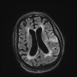 MRI Brain Axial FLAIR