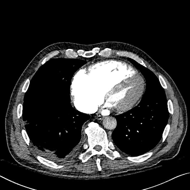 RV/LV >1 in acute pulmonary embolism