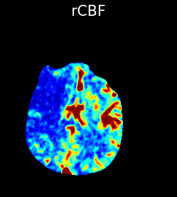 CBF<30% (infarct core) involving the right anterior MCA distribution