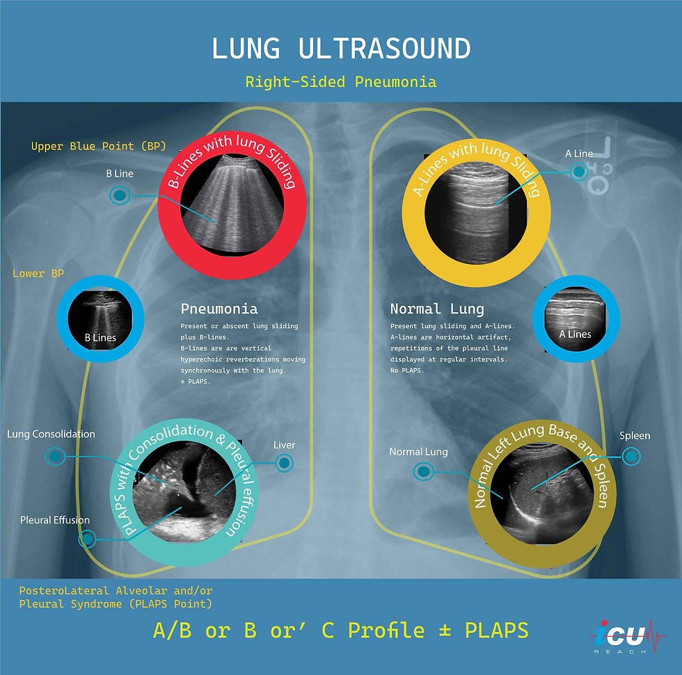 Blue protocol, Ultrasound for pneumonia in the ICU