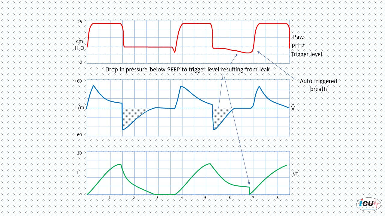 Auto Triggering in Mechanical Ventilation