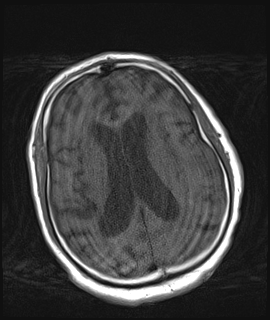 MRI Images T1, T2, and FLAIR