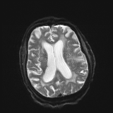 MRI Brain Axial T2