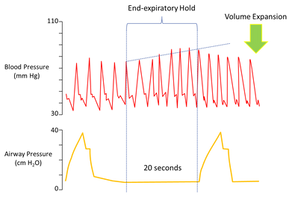 How End-expiratory Occlusion test (EEO) Test Can Help Assess Fluid Responsiveness in ICU Patients!