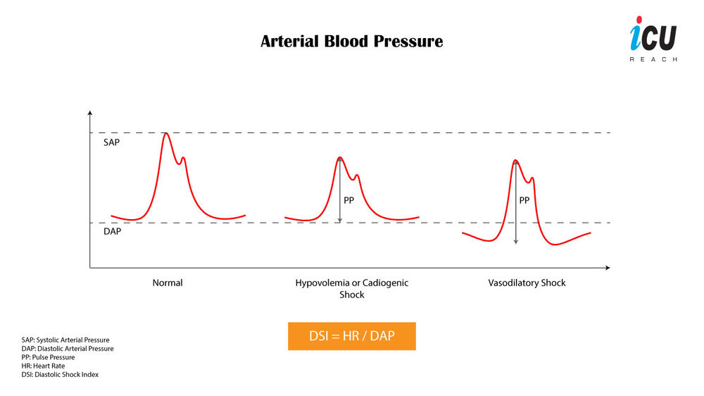 Diastolic Shock Index What it Means and how is it Interpreted?