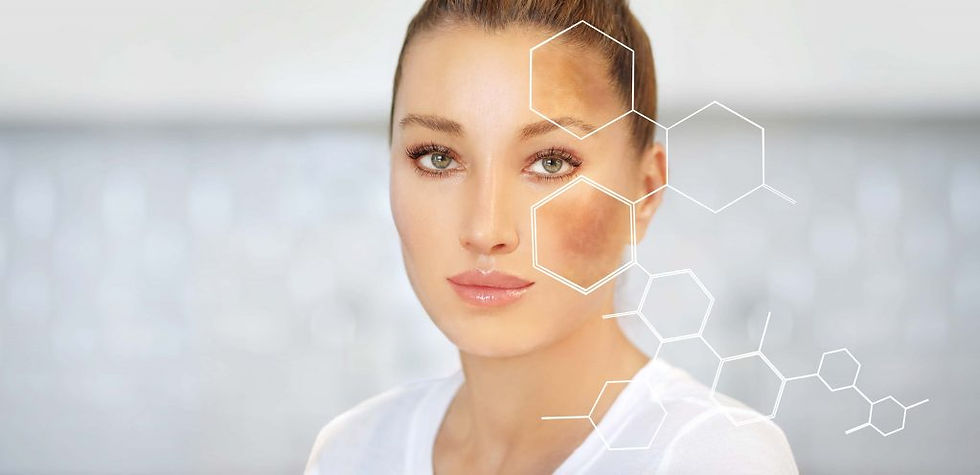 Melasma
