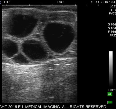 Ovum Pick-up with Ultrasonography