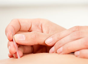 Acupuncture session targeting back pain