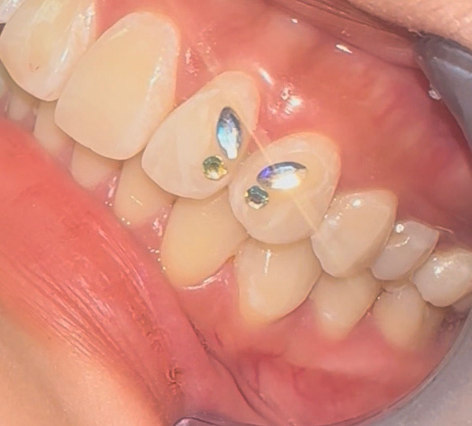 TOOTH GEMS
