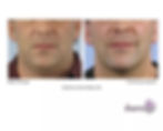 face thermage in markham firming and tighting loose face skin